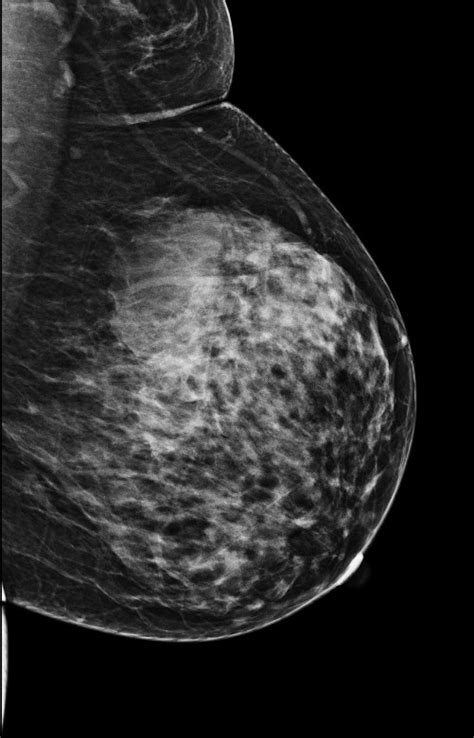 Ectopic Axillary Breast Tissue Image