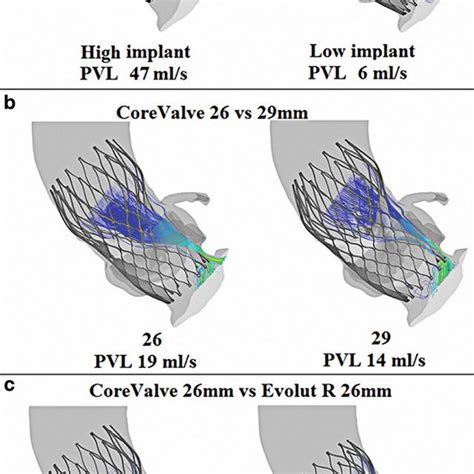 Supra Versus Intra Annular Valve Design The Thin Arrow Denotes The