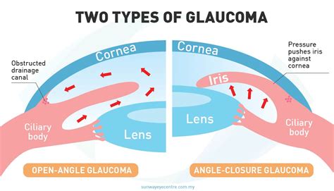 The Two Types Of Glaucoma Primary Open Angle Glaucoma And Primary Angle