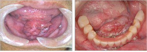 レカセブン (1) エターナルアルカディア (16) オクトパストラベラー (5) オトコのコはメイド服がお好き!? 下顎の歯ぐきの内側と舌の間の部分にできる癌である口底癌と ...