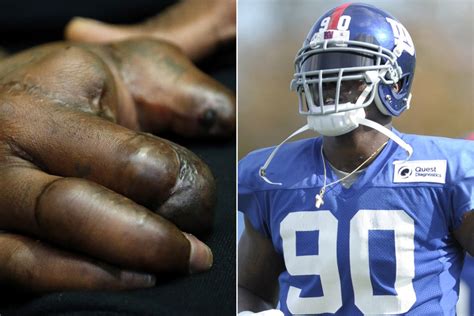 Jpp Reveals Mangled Right Hand As He Relives Fireworks Mishap