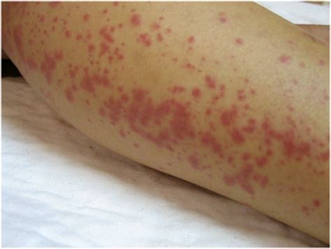 Maculopapular Rash Causes Symptoms Treatment Pictures Diagnosis