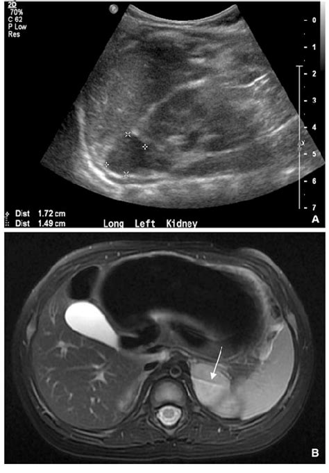 Normal Pediatric Renal Ultrasound