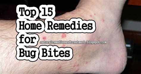 Top 15 Home Remedies For Bug Bites Natural Remedies And Treatment