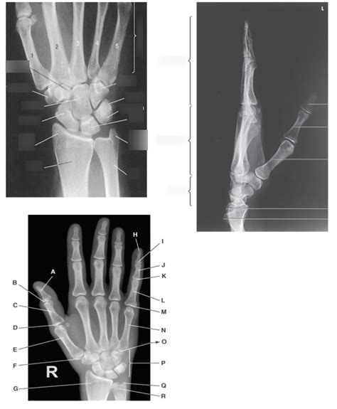 Hand And Wrist Radiograph Diagram Quizlet
