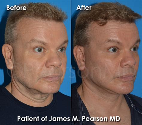 Plastic Surgery For Men Dr James Pearson Facial Plastic Surgery