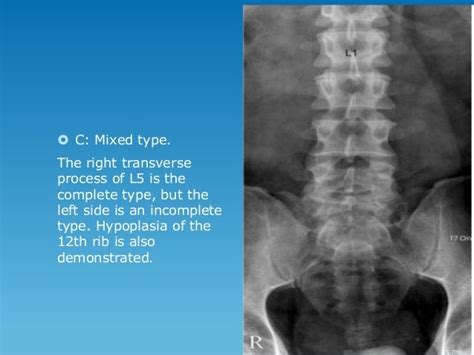 Transitional Vertebrae Radiology