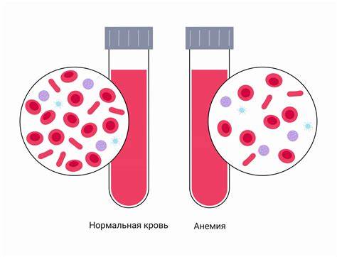 Анемия постгеморрагическая диета Анемия (малокровие): симптомы, что это за болезнь, признаки, лечение Анемия (малокровие): симптомы, что это за болезнь, признаки, лечение Анемия постгеморрагическая диета