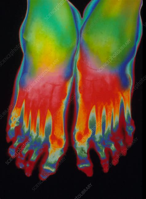 Coloured X Ray Of Rheumatoid Arthritis Of Feet Stock Image M110