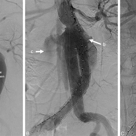 Preoperative Images Of Patient With Aortocaval Fistula And Ruptured