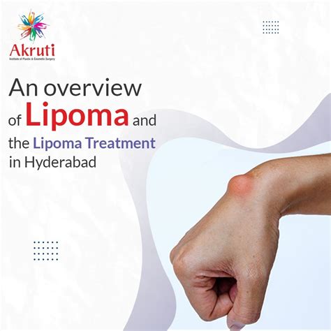 Lipoma Treatment In Hyderabadlipoma Surgery In Hyderabad