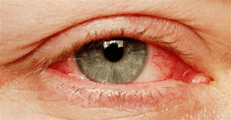 Eye Redness Its Causes And Prevention Marham