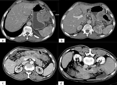 Transverse A Contrast Enhanced Ct Image In A 66 Year Old Patient