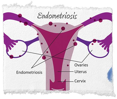 Ce Este Endometrioza Simptome Si Metode De Tratament Topnaturiste My XXX Hot Girl