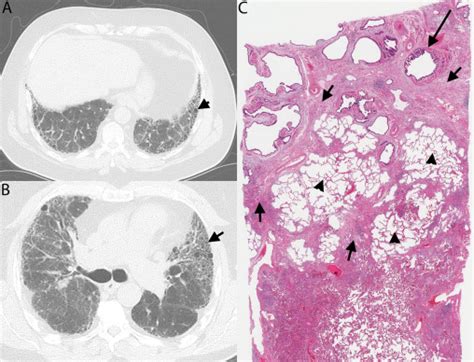 Usual Interstitial Pneumonia Uip A Clinically Significant Pathologic