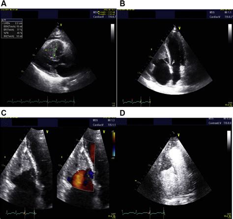 Myocarditis Echocardiography Findings / Racgp Transthoracic Echocardiography Findings ...