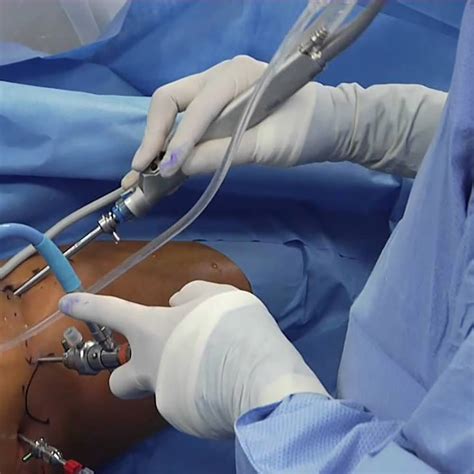 Hip Arthroscopy Minimally Invasive Surgery Explained Precision