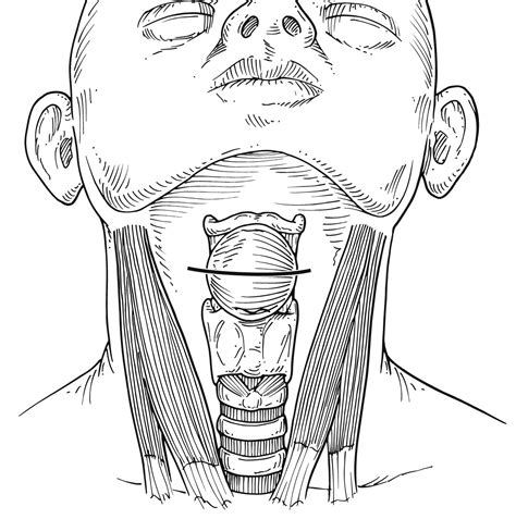 Cervical Dermoid Cysts Operative Techniques In Otolaryngology Head