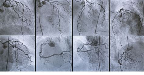 Coronary Angiography All You Need To Know About The Procedure
