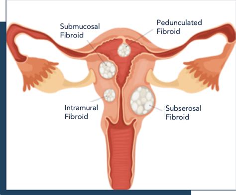 Fibroid Types Sizes Location FIGO Classifications Explained