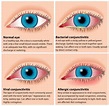 Pink Eye (Conjunctivitis) Symptoms, Treatments And Prevention ...