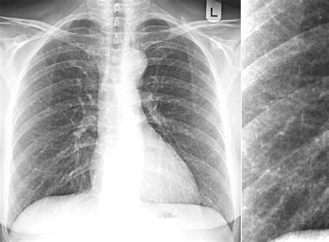 Chest X Ray Pneumonia Vs Bronchitis Bronchitis Contagious