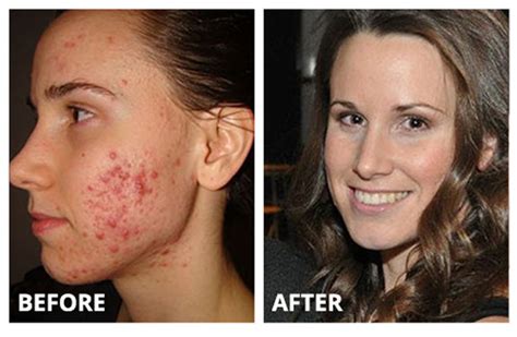 How To Get Rid Of Red Acne Scars