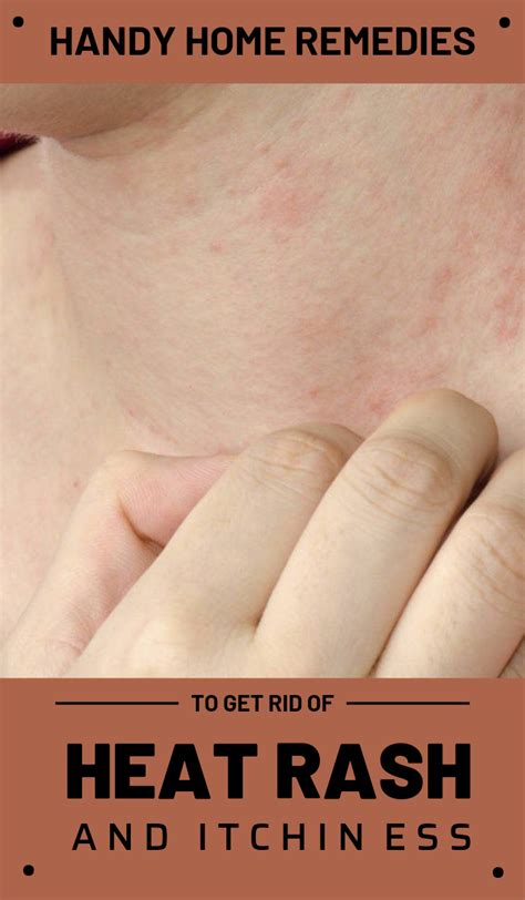 Handy Home Remedies To Get Rid Of Heat Rash And Itchiness Heat Rash