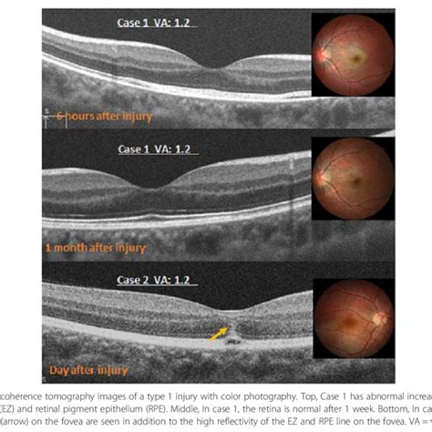 Fundoscopy And Oct At Presentation Notes A Fundoscopy At