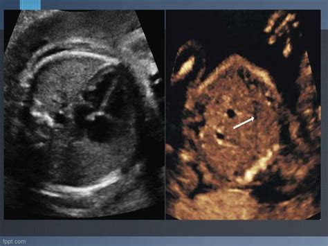 Ultrasound Evaluation Of Fetal Thorax