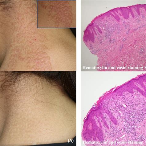 A Skin Examination Revealed Unilateral Confluent Lichenoid Eruption On