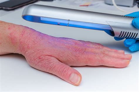 Phototherapy Safe Effective For Psoriasis