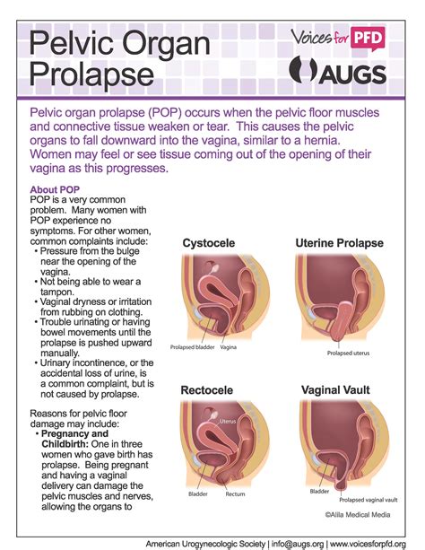 Stages Of Bladder Prolapse