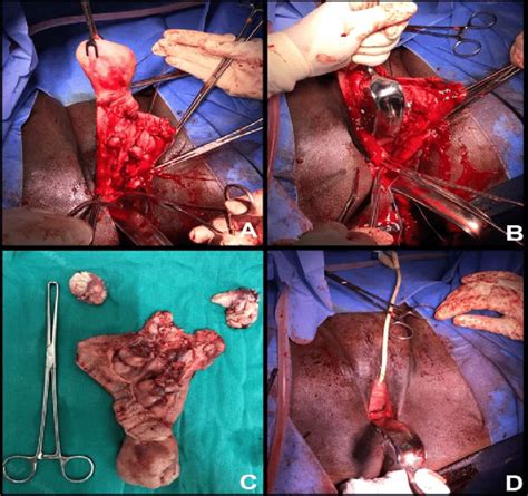 A Uterine Prolapse With Inverted Uterus B Mobilization Of The