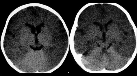 Ct Reversal Sign Is Observed Due To Diffuse Cerebral Anoxia In