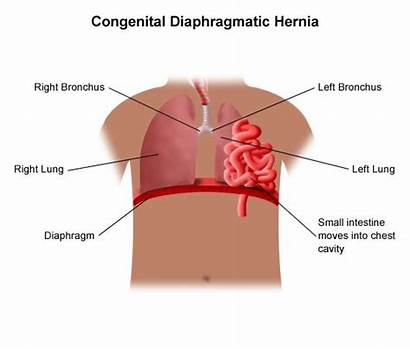 Diaphragmatic Hernia Left Congenital Sided