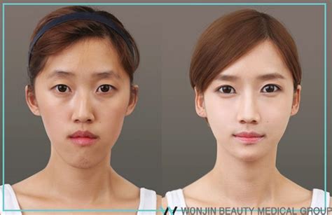 Korean Two Jaw Surgery Wonjin Plastic Surgery Clinic Korea