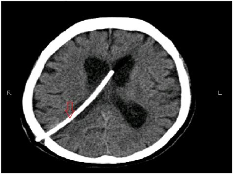Normal Pressure Hydrocephalus Secondary To Intracranial Mass A Case Series
