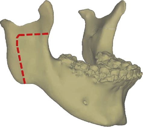 Inverted L Osteotomy Diagram Download Scientific Diagram