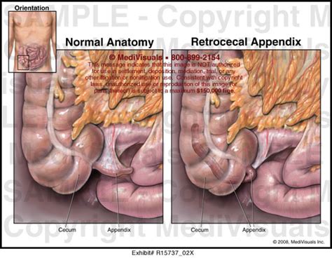 Retrocecal Appendix R1573702x