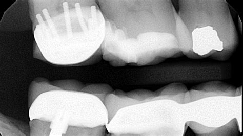 I Spyhow Many Pins In This Tooth Dentistry Iq