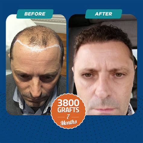 Sapphire FUE Hair Transplant In Turkey DR CELEN