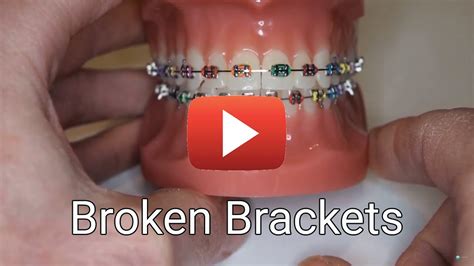 Broken Brackets Youtube