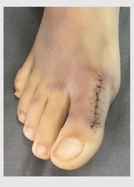 Sutured Wound And Final Clinical Alignment Of The Hallux Download
