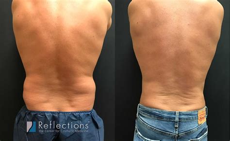 Male Lipo To Get Rid Of Love Handles Without Anesthesia Or Long Downtime Before After Photos