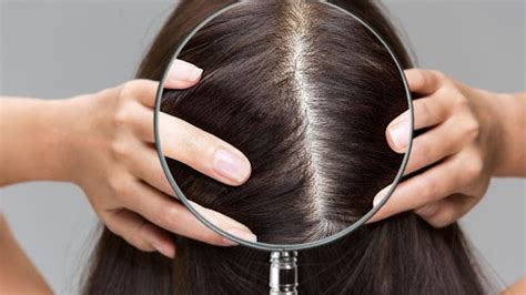 How To Get Rid Of Dandruff Get Healthy Scalp And Hair Growth