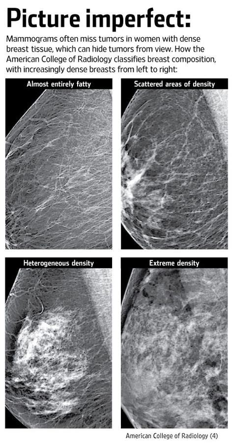 Does Mammogram Detect Inflammatory Breast Cancer ️updated