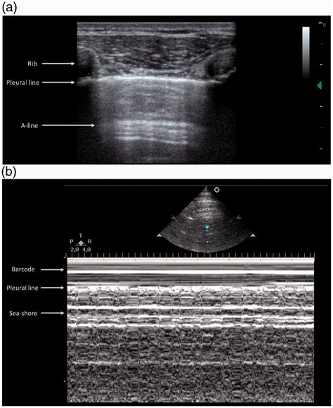 Lung Ultrasound In Blunt Chest Trauma A Clinical Review Serena