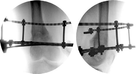 Ap And Lat Radiographs Of The Distal Femur 5 Months After Surgery
