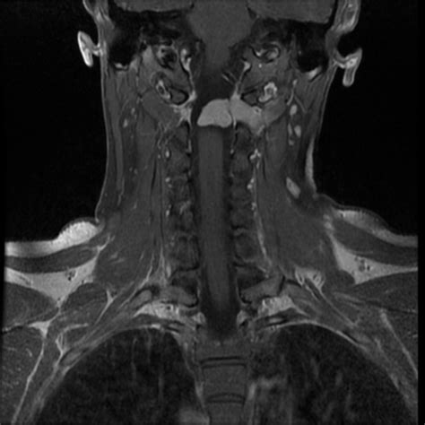 Malignant Melanotic Nerve Sheath Tumor Image